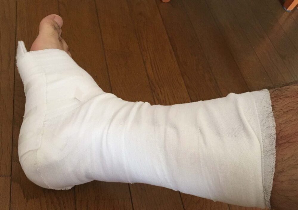 ギプスシーネで固定されたアキレス腱