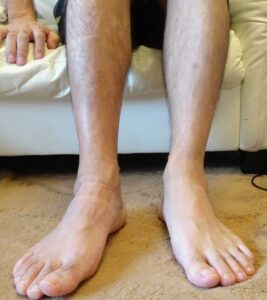 アキレス腱断裂手術5ケ月後の完治通院時のアキレス腱