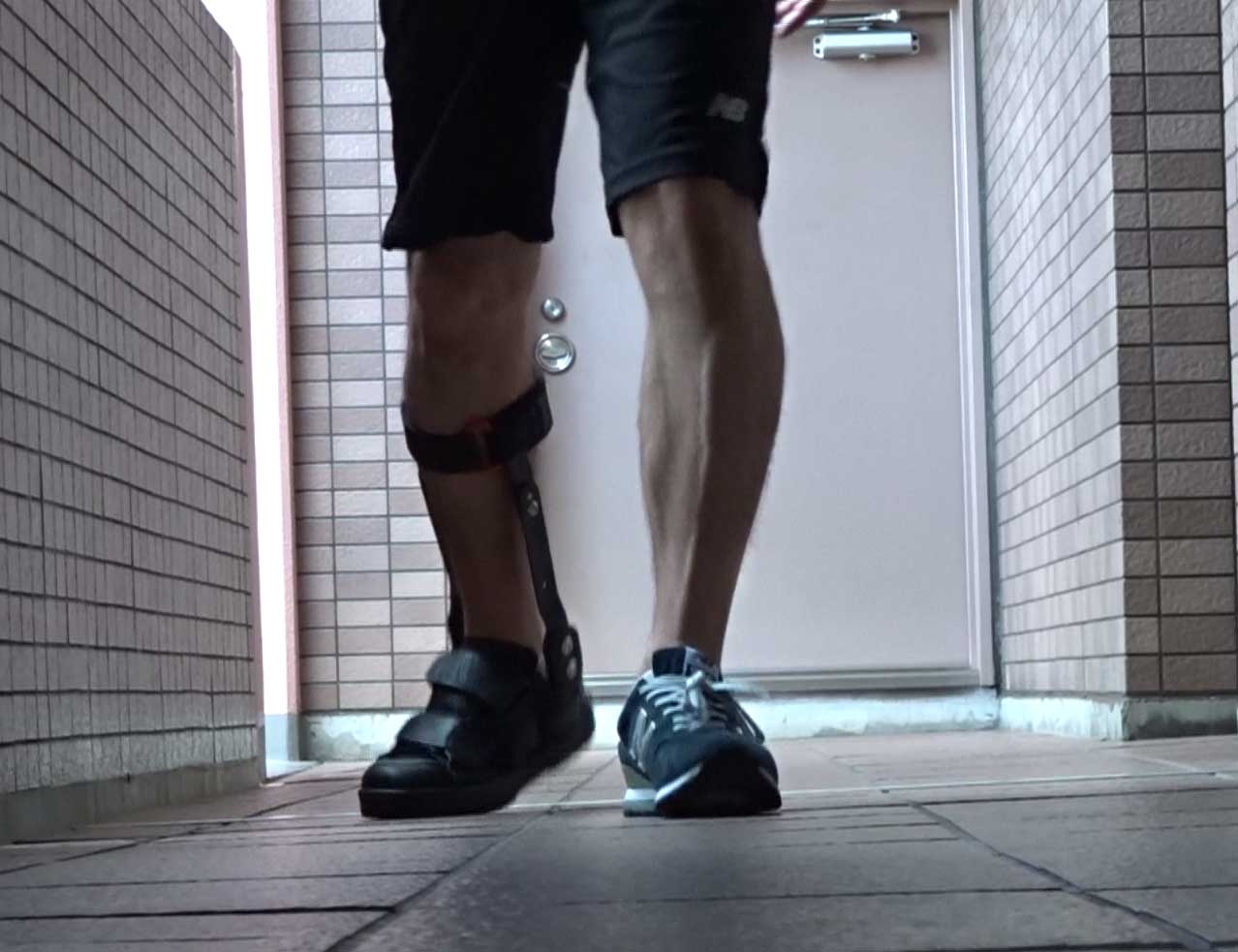 アキレス腱断裂手術１ケ月後